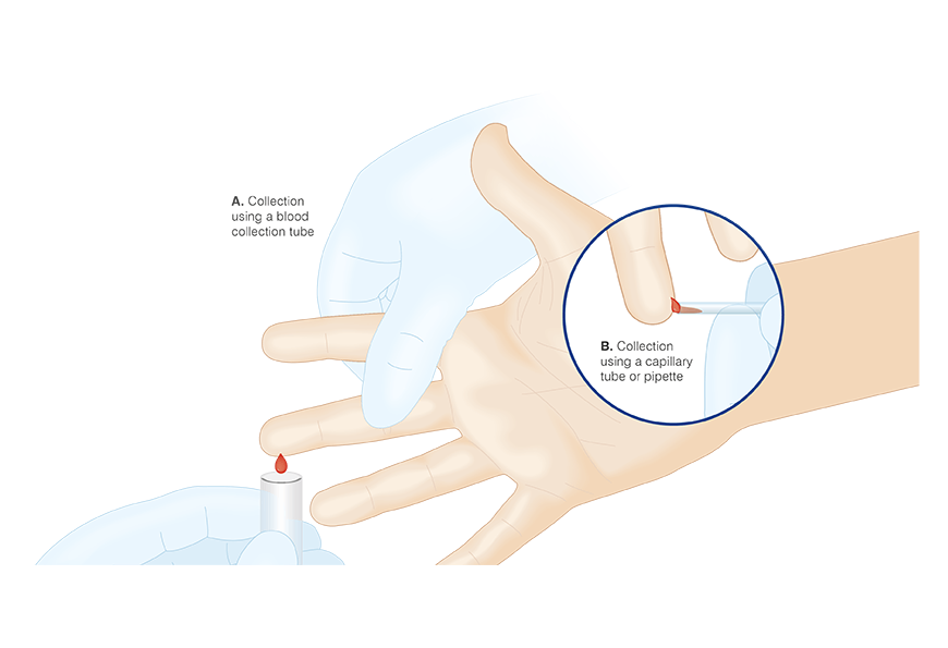 Collecting a finger capillary blood sample